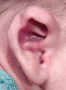 Microtia