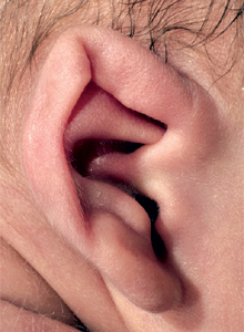 Cryptotia ear